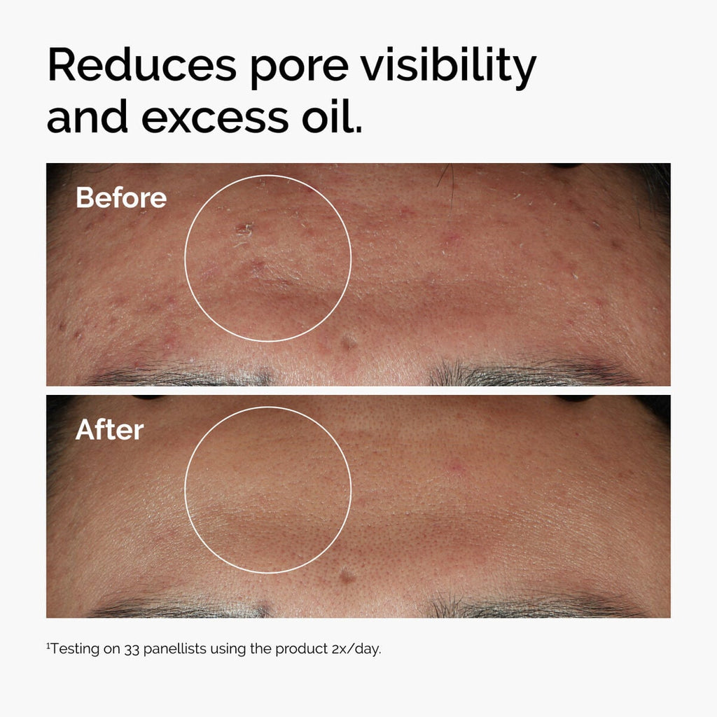 niacinamide-10-zinc-1-h1 ord-niacinamide-zinc-blemish-serum-before-after-pores.jpg