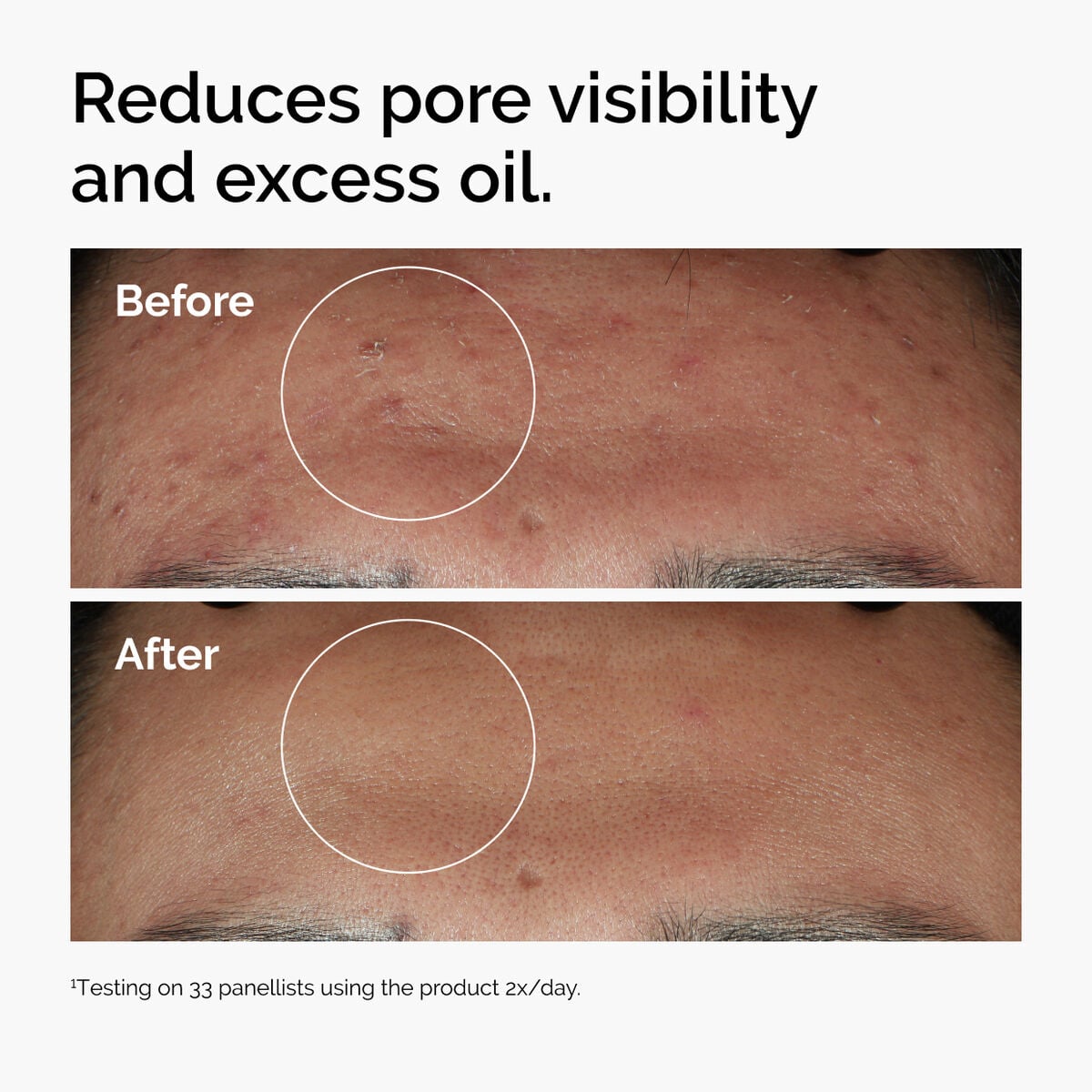 niacinamide-10-zinc-1-h1 ord-niacinamide-zinc-blemish-serum-before-after-pores.jpg