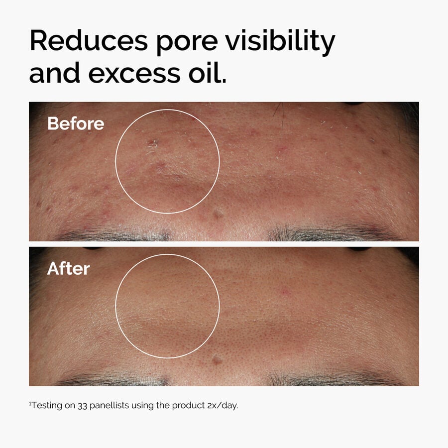niacinamide-10-zinc-1-h1 ord-niacinamide-zinc-blemish-serum-before-after-pores.jpg