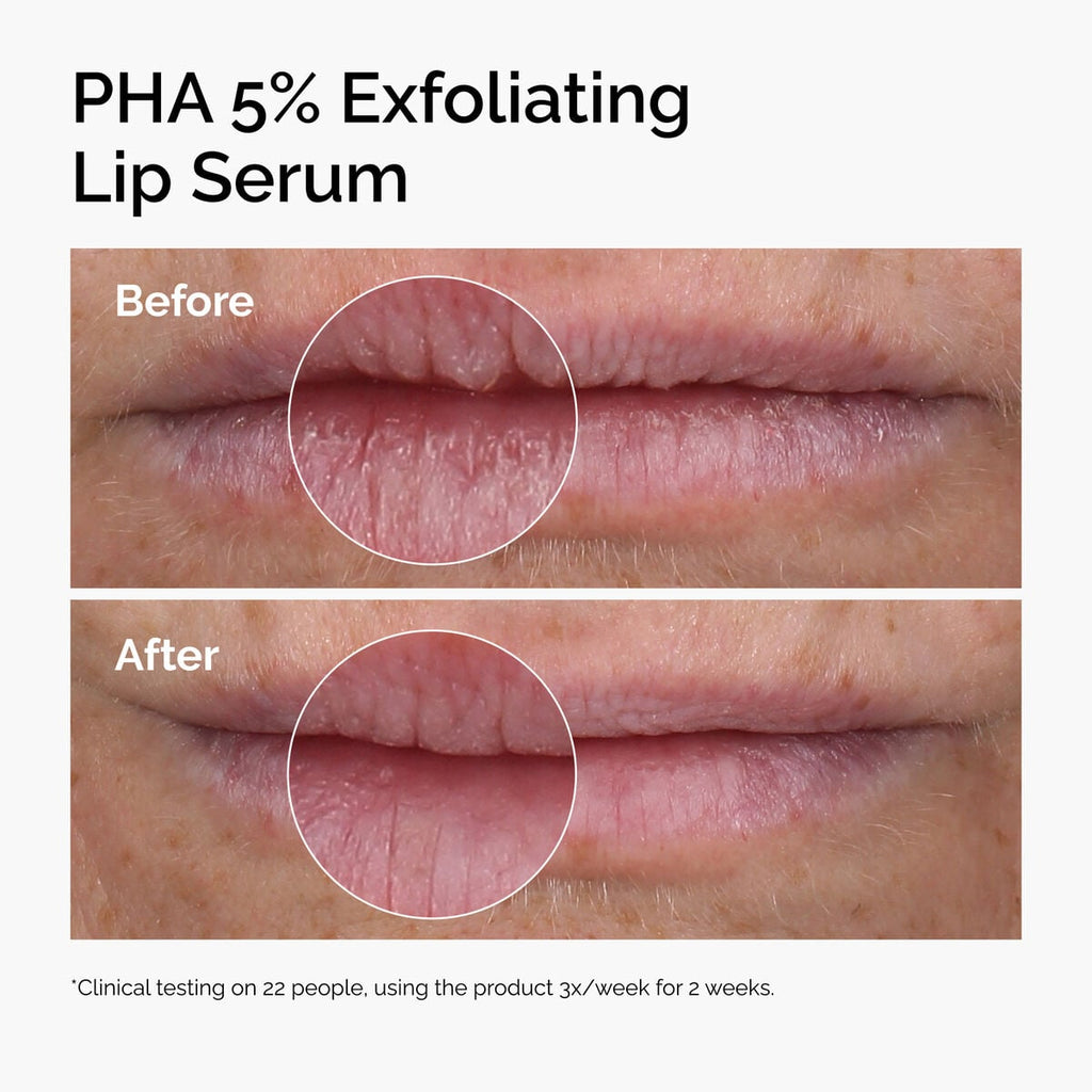 pha-5-exfoliating-lip-serum-b3 ord-pha-5pct-lip-exfoliating-serum-before-after.jpg