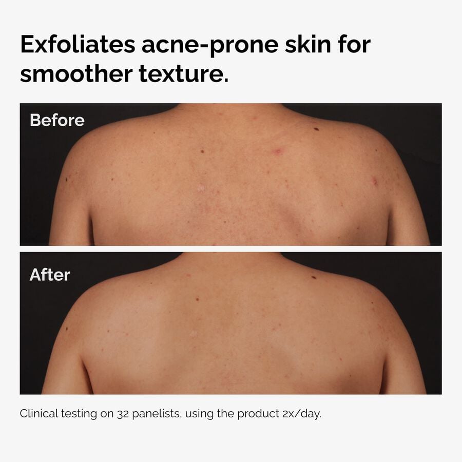 salicylic-acid-0-5-body-serum-z0 ord-salicylic-acid-body-serum-before-after-graphic-NA.jpg