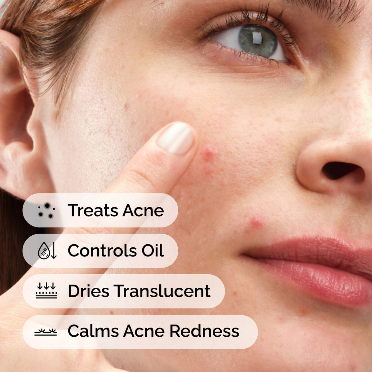 sulfur-10-powder-to-cream-concentrate-s4 ord-sulfur-10pct-powder-to-cream-concentrate-model-application-with-benefits-acne.jpg