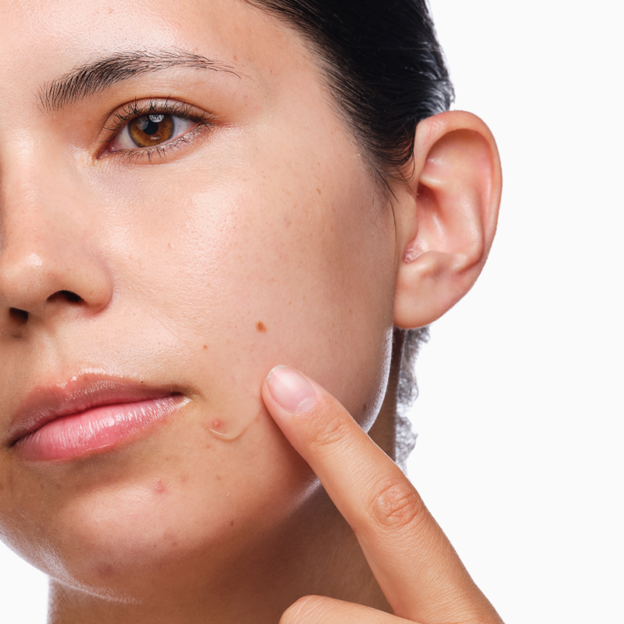 the-acne-set-l3 rdn-the-acne-set-application.png